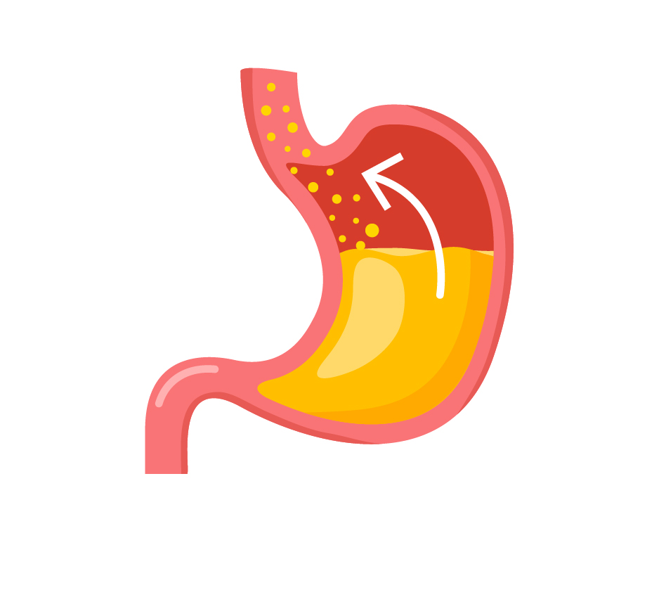illustrazione di uno stomaco con reflusso gastroesofageo